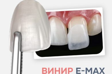 Винир Emax