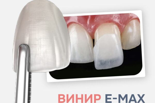 Винир Emax